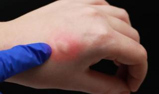 为什么有些人招蚊子